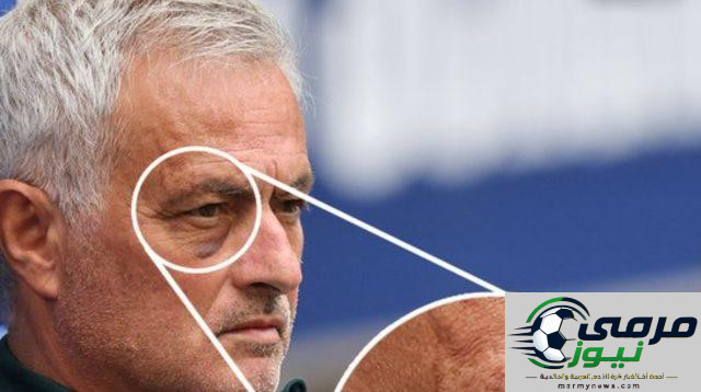 ما الذي تكشفه كدمة مورينيو؟ فورجانيس يقدم الإجابة.