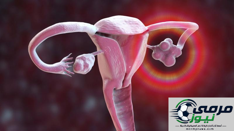 ما الذي ينبغي معرفته عن متلازمة تكيس المبايض؟